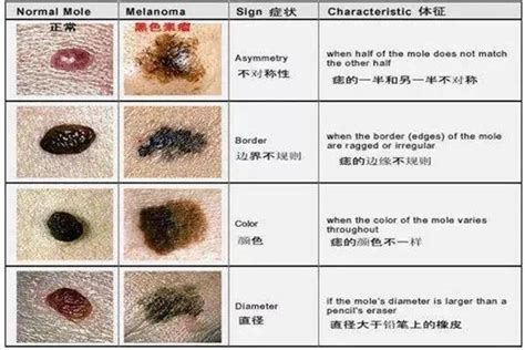 身上有痣|一图读懂：什么样的痣易癌变？